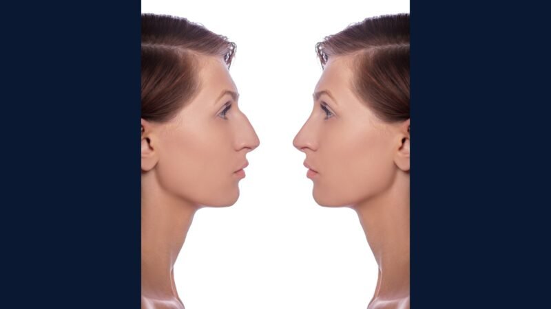 RSS plástica facial: rinoplastia, blefaroplastia